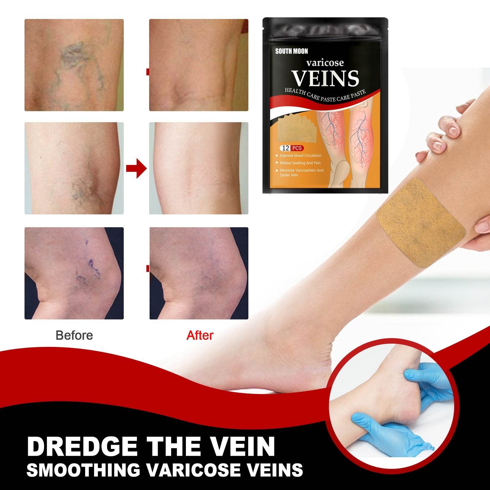 Venous health patch relieves varicose blood vessel blockage and protrusions in the feet. Cold compress venous health patch - MarvelouStoree