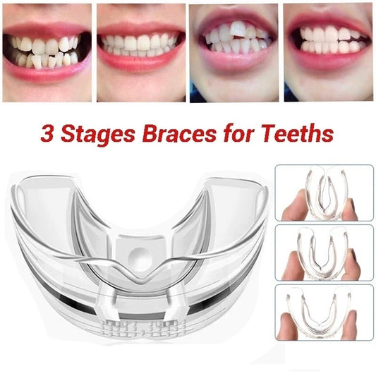 3 Stages Dental Orthodontic Braces Appliance Braces Alignment Trainer Teeth Retainer Bruxism Mouth Guard Teeth Straightener