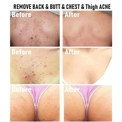 Body Acne Removal Cream Treatment Face Butt Back Acne Marks Smooth Repair Chicken Skin Cream Moisturizing Whitening Skin Care