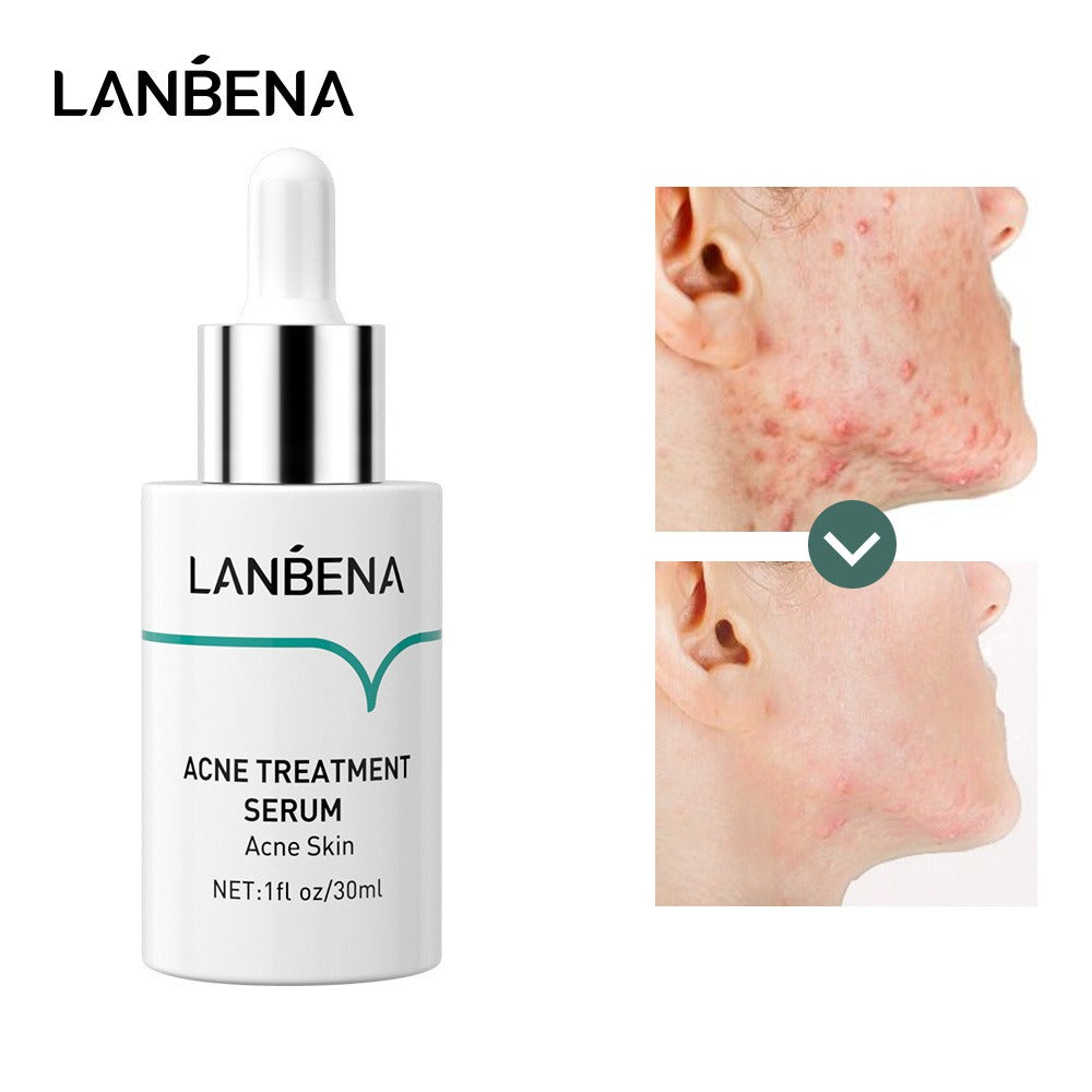 LANBENA ACNE TREATMENT SERUM