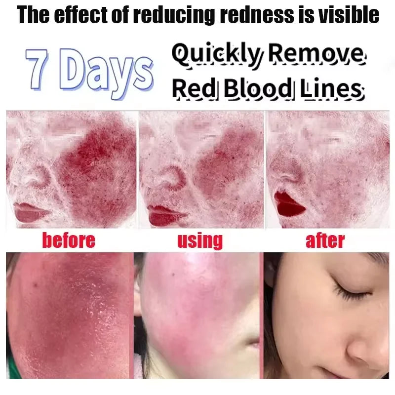 Instant Facial Redness Repair Cream Soothing Red Blood Rosacea Treatment Improve Sensitive Skin Anti Redness Skin Care Cosmetics