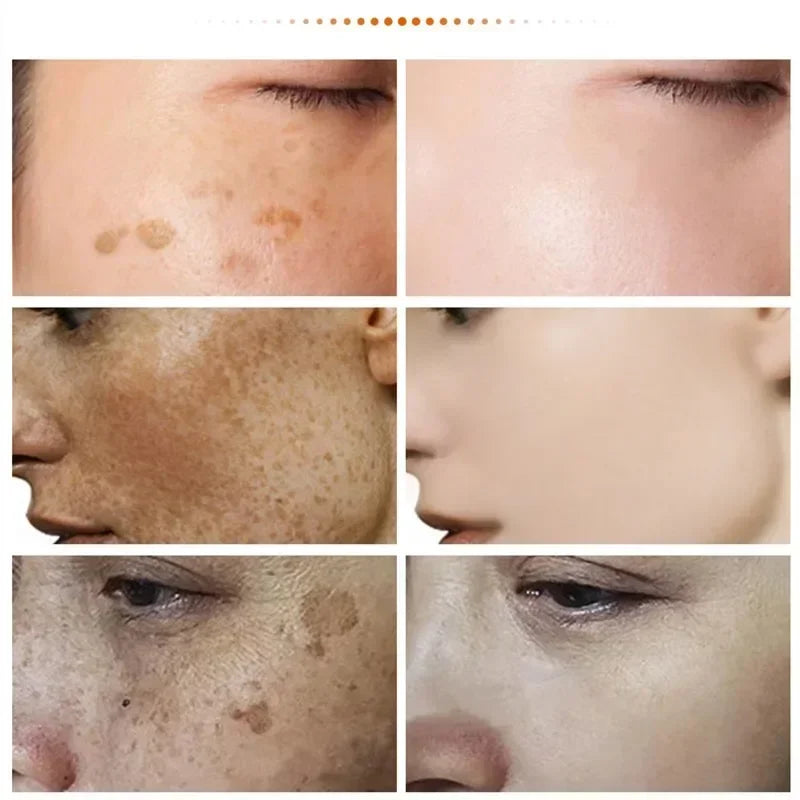 Niacinamide Melasma Brightening Cream Reduce Melanin Brighten Cream Lighten Dark Skin Chloasma Serum Fade Fine Face Lines 2024