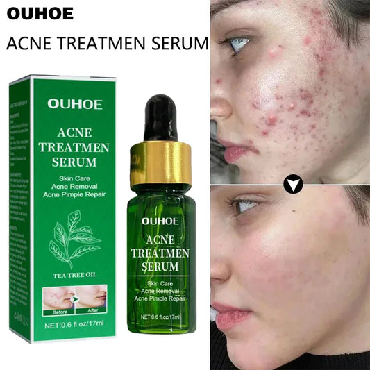 Acne Treatment Facial Serum Pore Shrinking Skin Care Against Face Acne Pimple Spots Remover Cleaning Shrink pores Tea Tree Serum