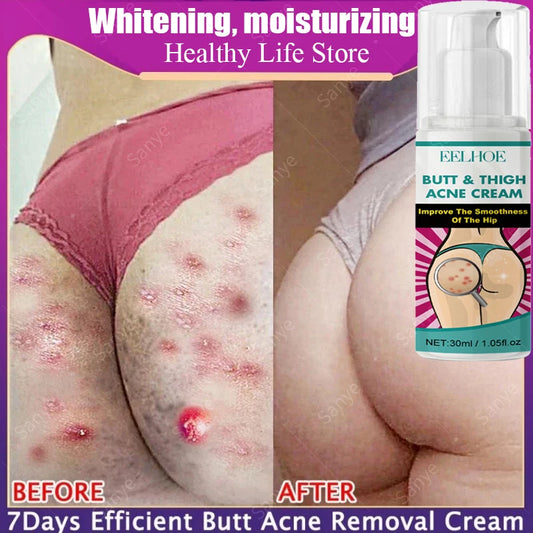 Inner Thigh Whitening Cream Butt Acne Treatment Serum Buttock Clearing Pimples Smooth Skin Care Fade Dark Spots Brighten Lotion