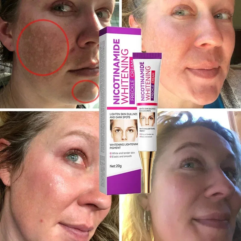 Lightening Melasma Brighten Lotion Effectively Fade Melanin Bleaching Cream Remove Dark Pigment Moisturizing Emulsion Skin Care