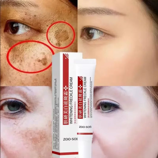 Powerful Spot-removing Whiten Cream Brighten Skin Fast Eliminates Melanin Pigmentation Melasma Dark Spots Korean Skin Care 2024