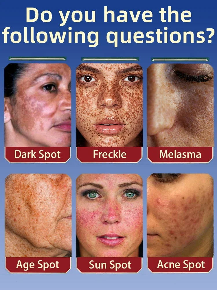 Freckles Cream Dark Spot