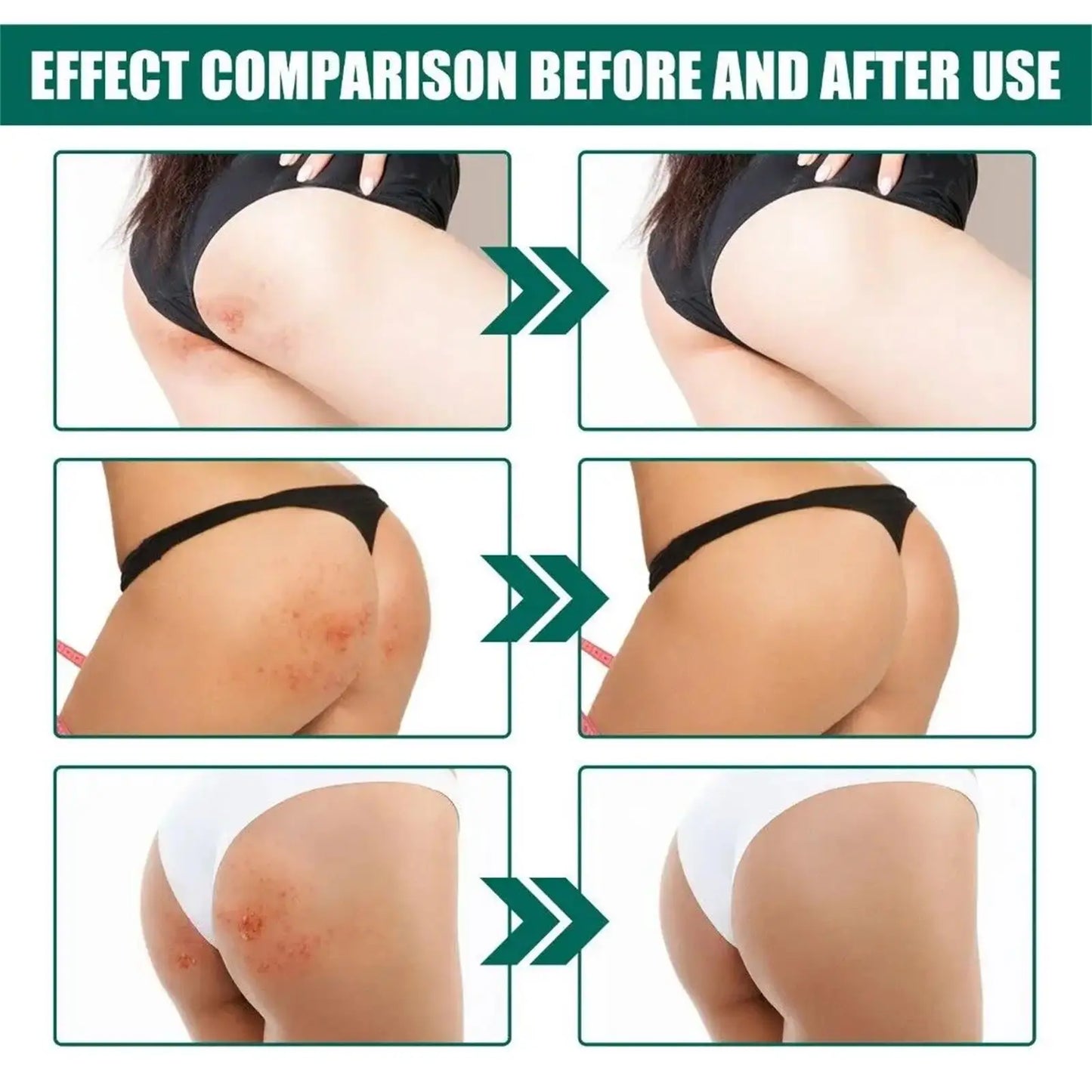 Body Acne Removal Cream Treatment Face Butt Back Acne Marks Smooth Repair Chicken Skin Cream Moisturizing Whitening Skin Care