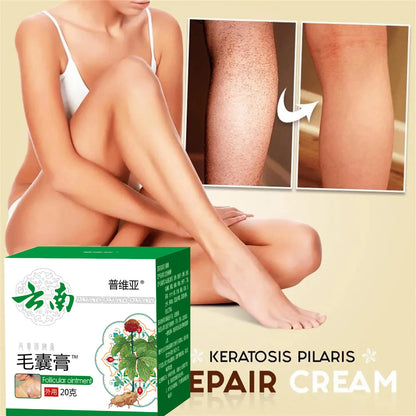 Body Acne Removal Cream Treatment Face Butt Back Acne Marks Smooth Repair Chicken Skin Cream Moisturizing Whitening Skin Care