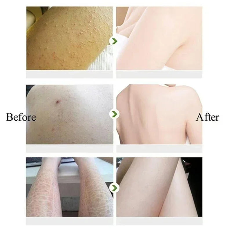 Chicken Skin Removal Treatment Body Scrub Cream Remove Dead Skin Cell Pore Spot Dull Whitening Moisturizing Body Care Cream