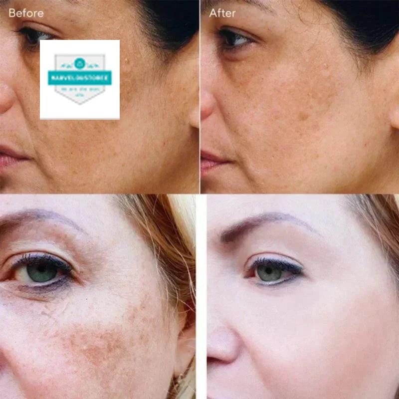 Effective Whiten Freckle Cream Brighten Face Remove Dark Face Spot Melasma Anti-pigmentation Improve Dullness Skin Care Cream