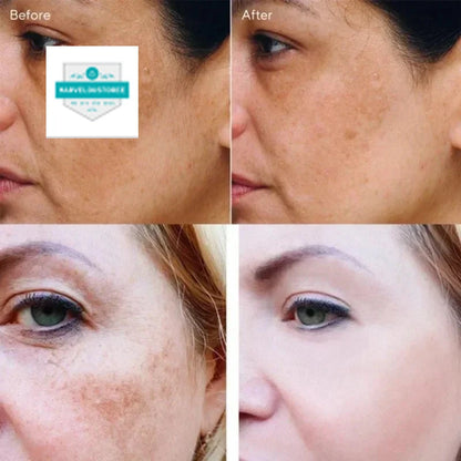 Effective Whiten Freckle Cream Brighten Face Remove Dark Face Spot Melasma Anti-pigmentation Improve Dullness Skin Care Cream