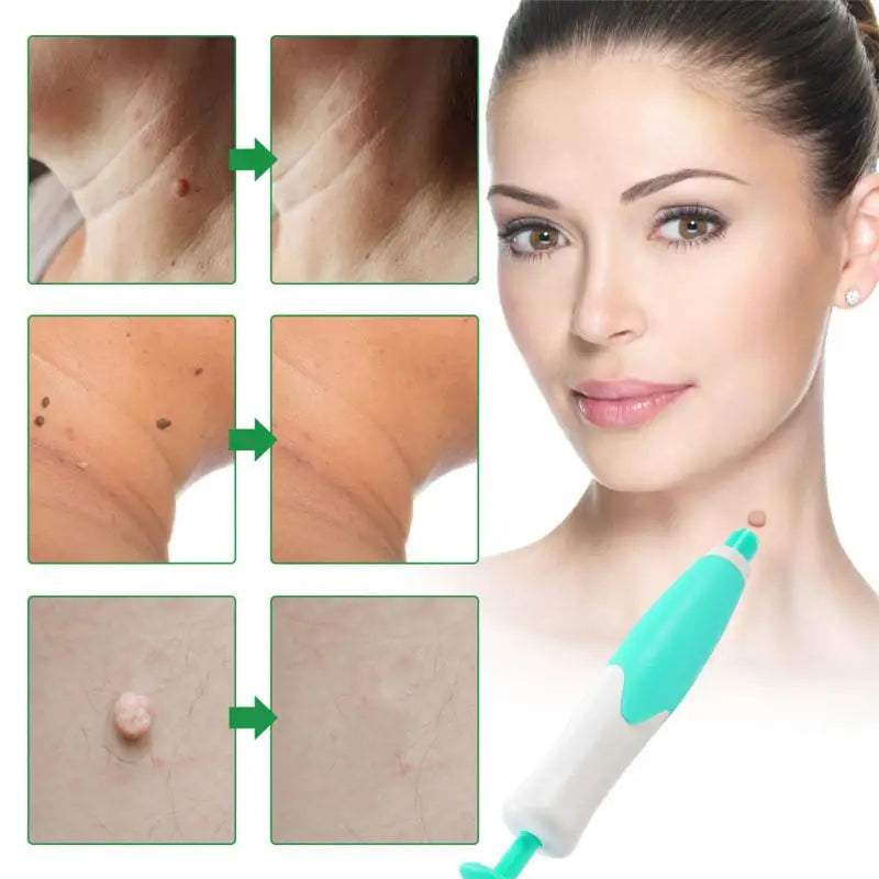 Skin Tag Removal Kit Easy And Painless Includes Cleansing Swabs Dermatologist Recommended Safe And Effective Safe Affordable