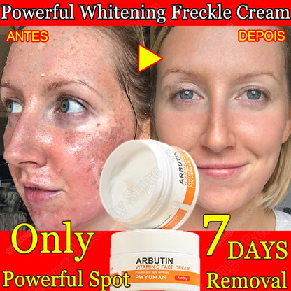 Powerful Whiten Freckle Cream Fast Remove Melasma Melanin Correcter Anti-Pigmentation Dark Spot Fade Improve Dullness Skin Care