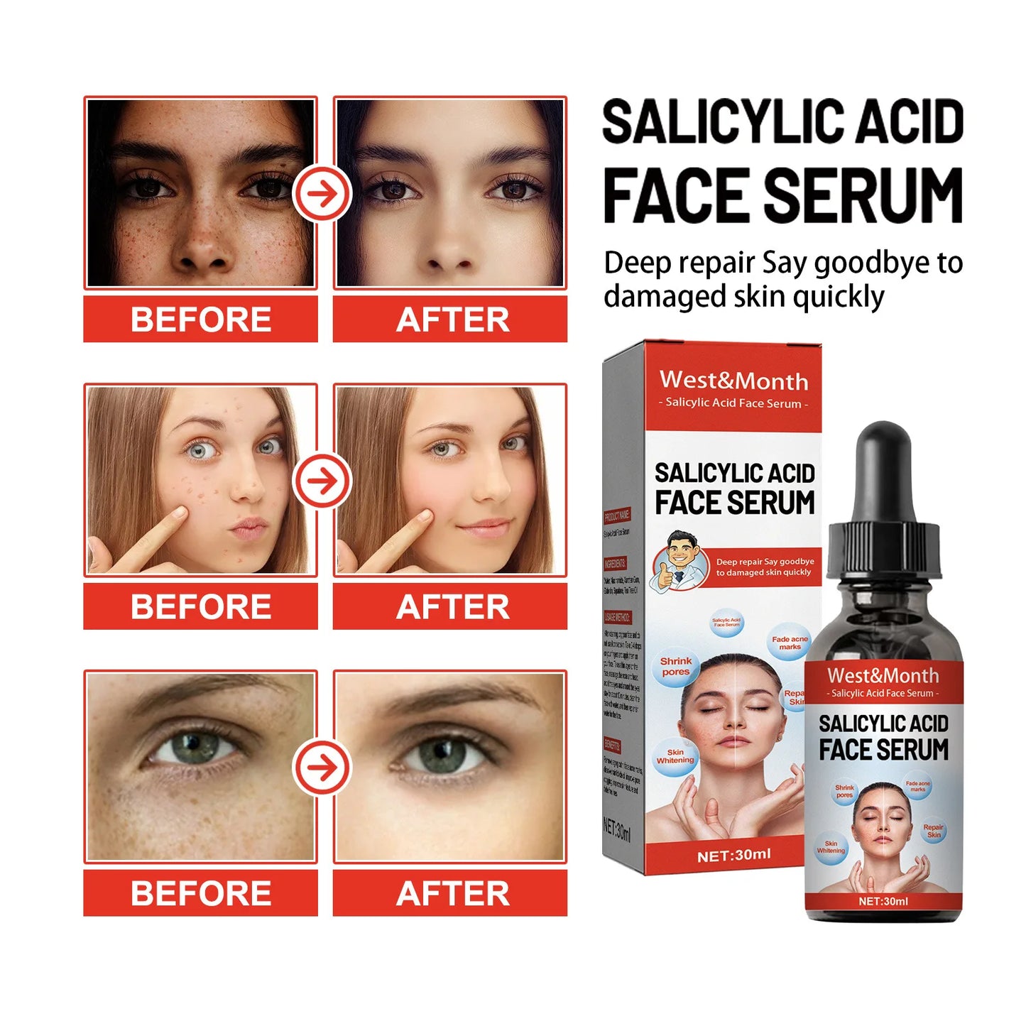 30ml Salicylic Acid Facial Serum Effectively Remove Melasma Lighten Dark Spots Acne Marks And Brighten Skin Tone