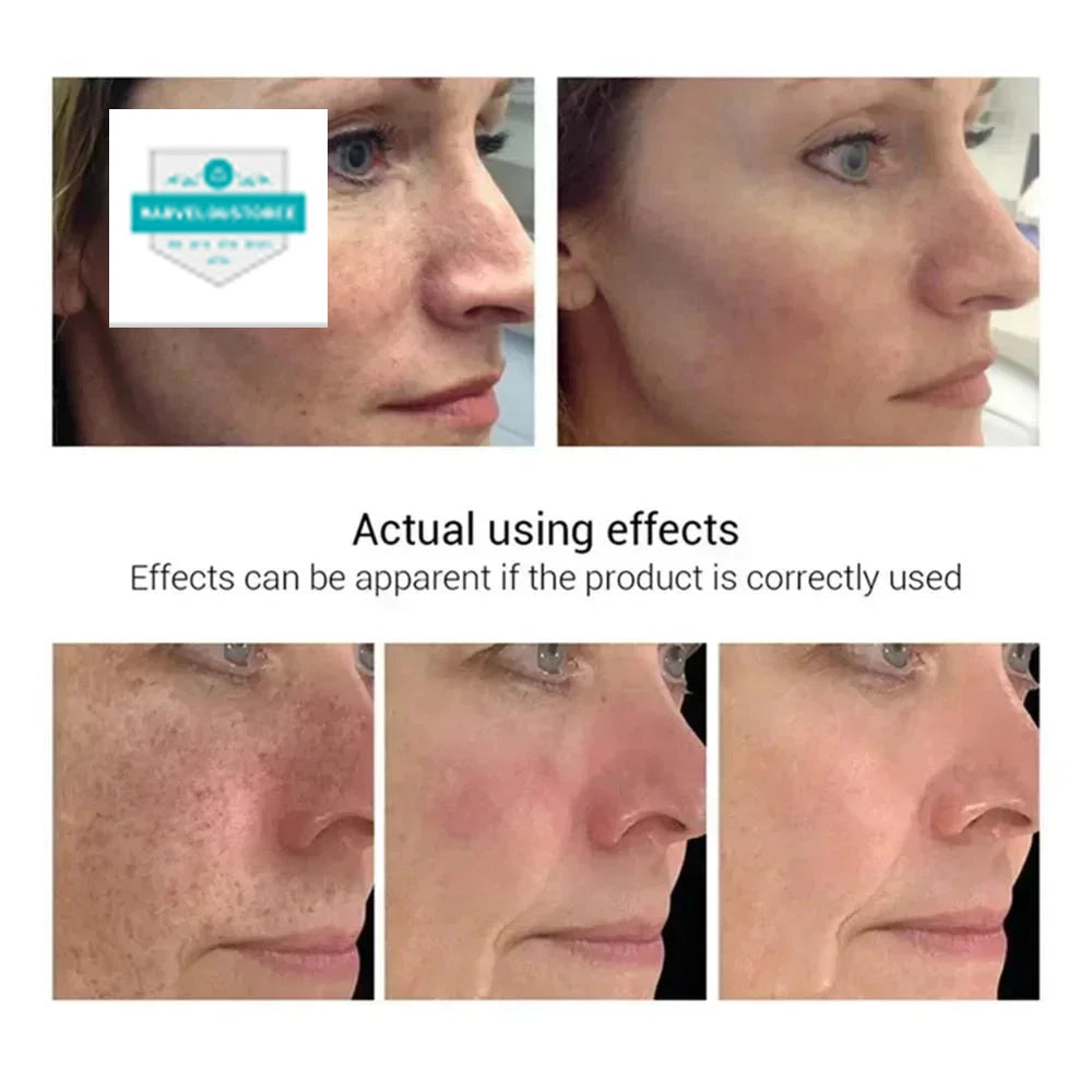 Effective Whiten Freckle Cream Brighten Face Remove Dark Face Spot Melasma Anti-pigmentation Improve Dullness Skin Care Cream