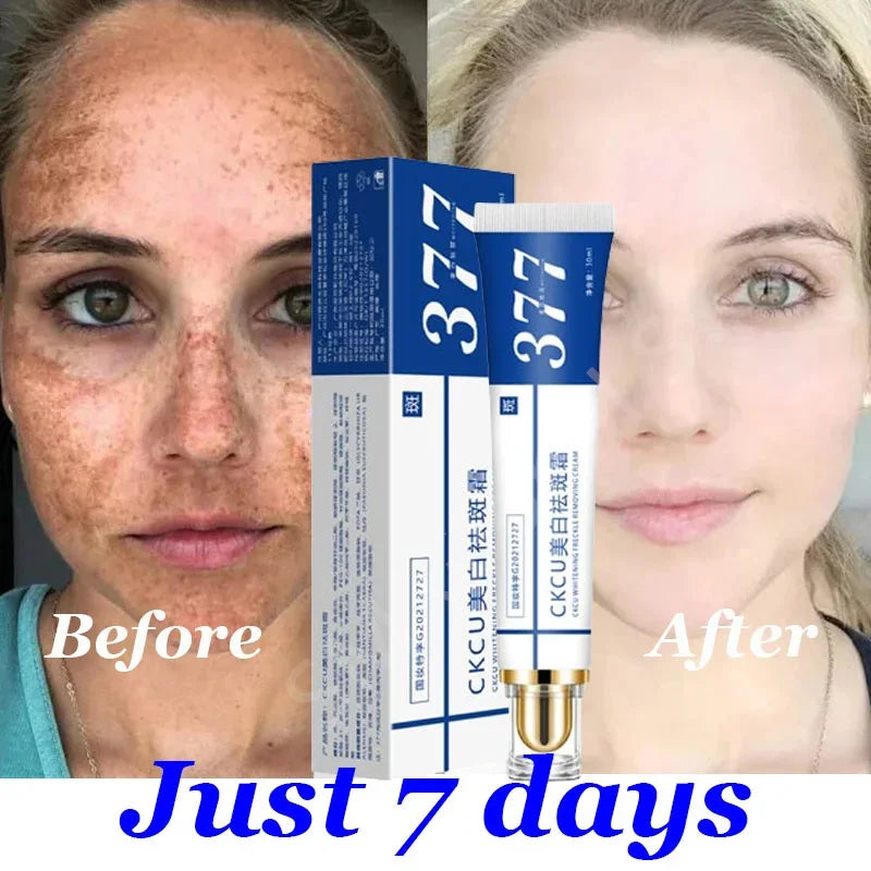 Whitening Freckle Cream Melasma Dark Spots Pigmentation Removal Products Fade Stain Melanin Repair Brighten Korean Skin Care