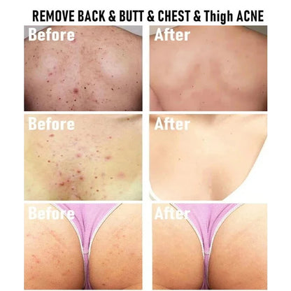 Body Acne Removal Cream Treatment Face Butt Back Acne Marks Smooth Repair Chicken Skin Cream Moisturizing Whitening Skin Care