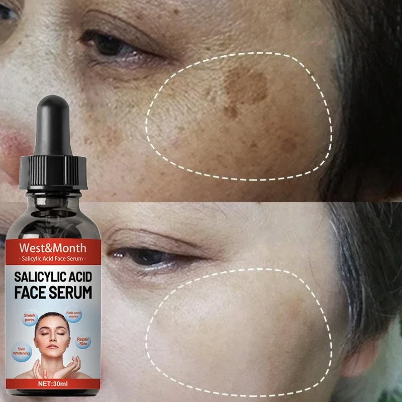 Niacinamide Attenuates Stains Freckle acne marks Facial Serum Salicylic Acid Shrinks Pores Moisturizing Skin Care Products 2024