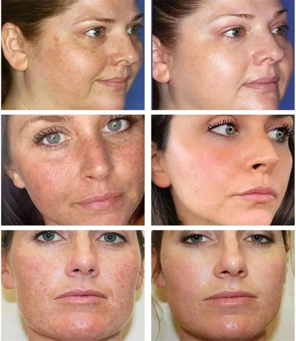 Effective Freckle Cream Fast Brighten Face Remove Melasma Dark Spot Fade Melanin Whiten Anti-pigmentation Improve Dullness Care