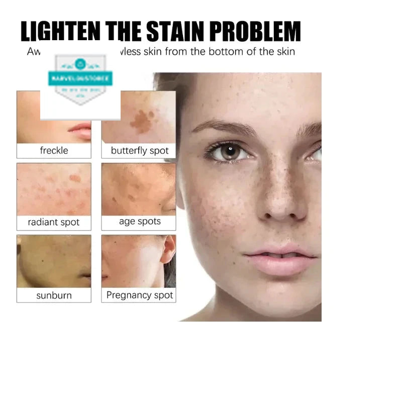 Effective Whiten Freckle Cream Brighten Face Remove Dark Face Spot Melasma Anti-pigmentation Improve Dullness Skin Care Cream