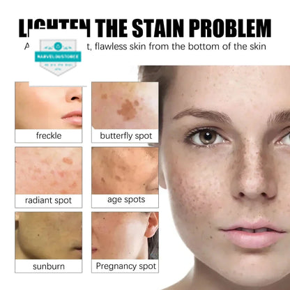 Effective Whiten Freckle Cream Brighten Face Remove Dark Face Spot Melasma Anti-pigmentation Improve Dullness Skin Care Cream