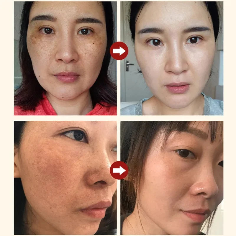 Effective Whitening Freckles Cream Remove Melasma Dark Spots Fade Pigmentation Moisturize Brighten Face Korean Skin Care Product