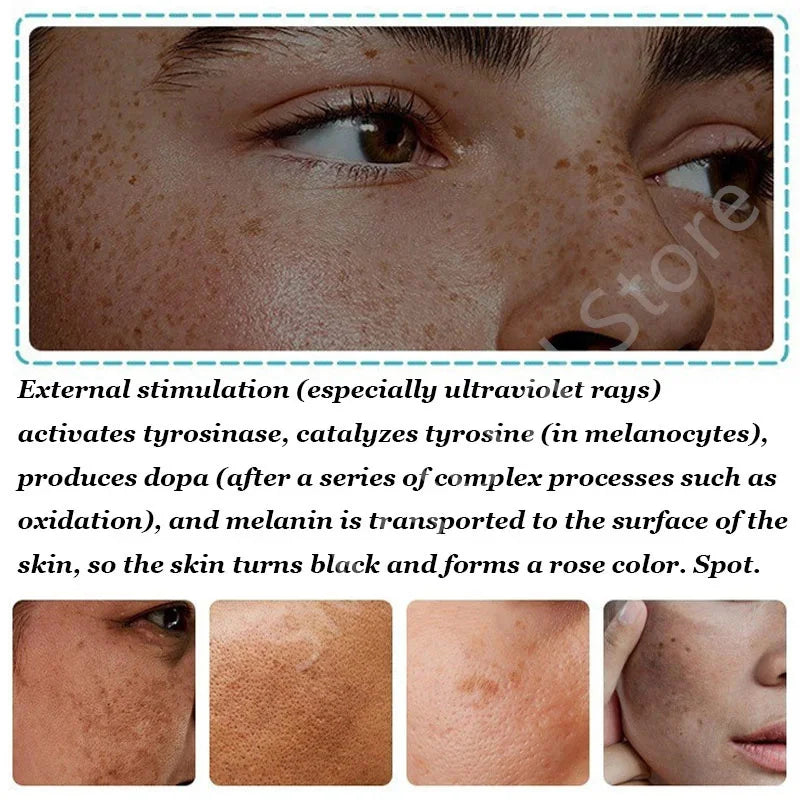 Whitening Freckle Cream Melasma Dark Spots Pigmentation Removal Products Fade Stain Melanin Repair Brighten Korean Skin Care