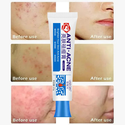 Anti-acne Treatment Cream Salicylic Acid Acne Deep Cleaning Pore Repair Pimple Spots Shrinking Oil Control Moisturizer Skin Care