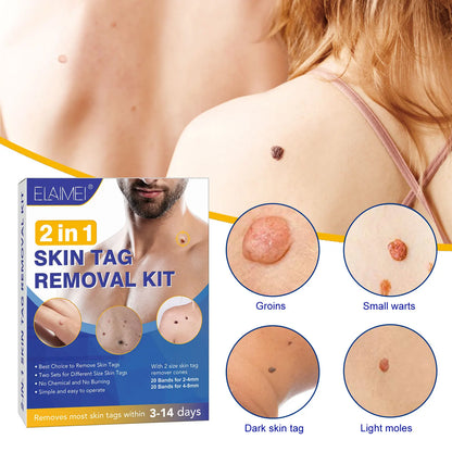 Skin Tag Remover Kit Mole Wart Remover Equipment Skin Tag Treatment Tool Facial Beauty Tool Home Use Easy To Clean