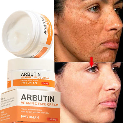 Powerful Whiten Freckle Cream Fast Remove Melasma Melanin Correcter Anti-Pigmentation Dark Spot Fade Improve Dullness Skin Care