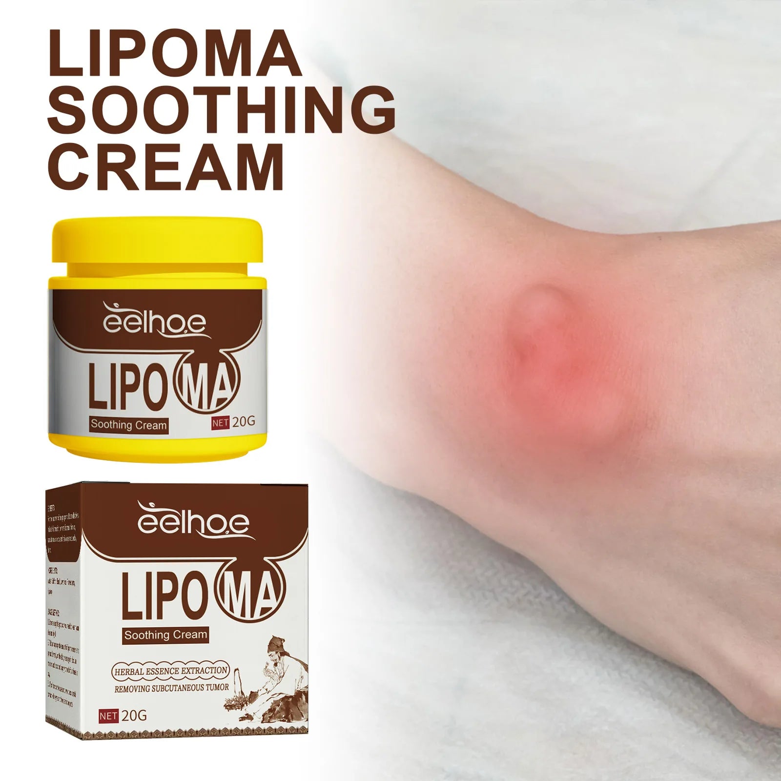 Lipoma Cream Subcutaneous Lumps Remover Treatment Medicine Liquid Apply To Skin Swelling Cellulite Fibroma Fat Mass Plaster