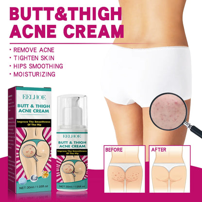 Inner Thigh Whitening Cream Butt Acne Treatment Serum Buttock Clearing Pimples Smooth Skin Care Fade Dark Spots Brighten Lotion