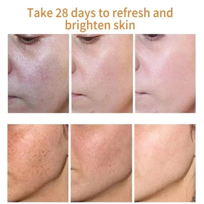 Effective Freckle Cream Fast Brighten Face Remove Melasma Dark Spot Fade Melanin Whiten Anti-pigmentation Improve Dullness Care