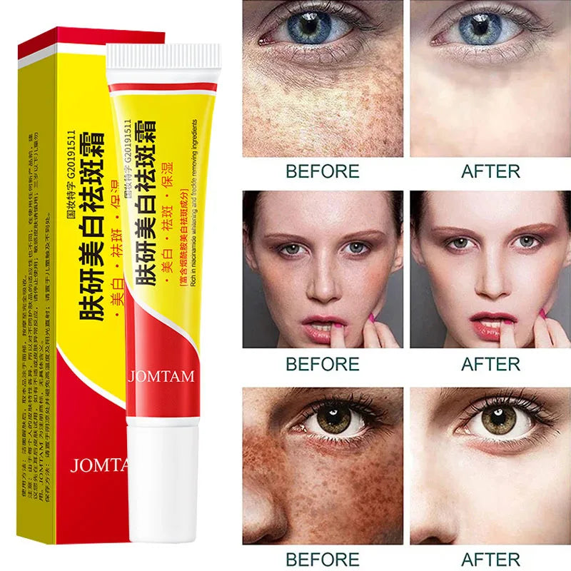 Effective Freckle Cream Fast Brighten Face Remove Melasma Dark Spot Fade Melanin Whiten Anti-pigmentation Improve Dullness Care