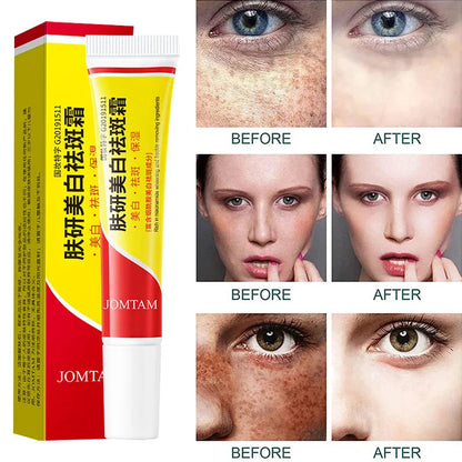 Effective Freckle Cream Fast Brighten Face Remove Melasma Dark Spot Fade Melanin Whiten Anti-pigmentation Improve Dullness Care