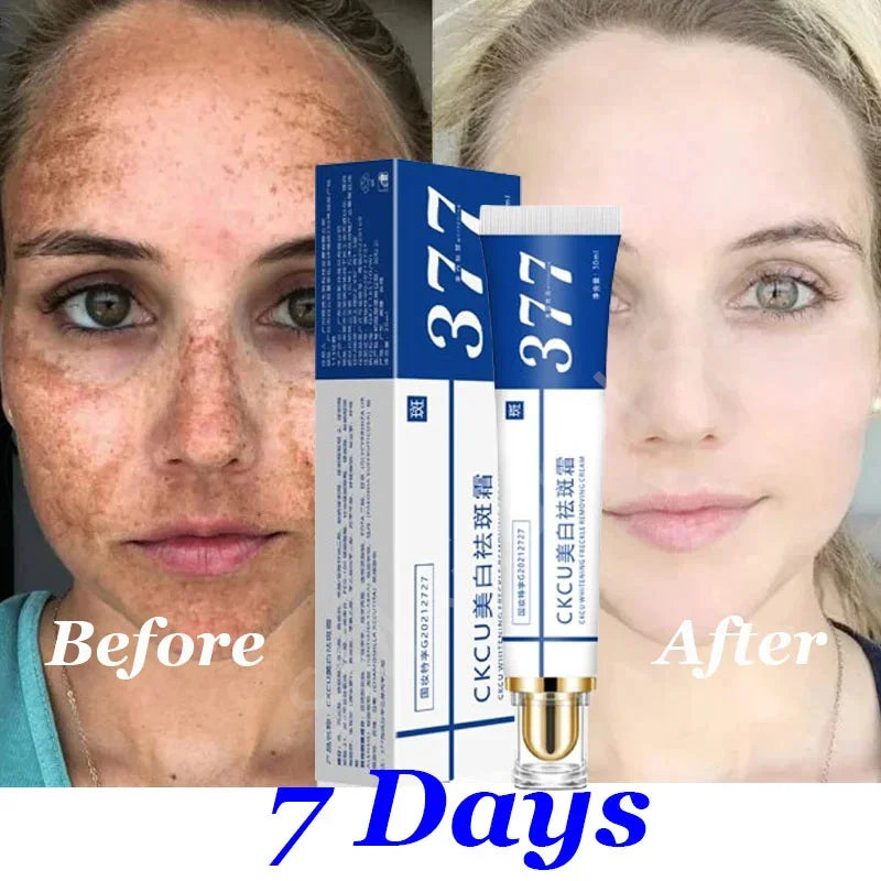 Whitening Freckle Cream Melasma Dark Spots Pigmentation Removal Products Fade Stain Melanin Repair Brighten Korean Skin Care