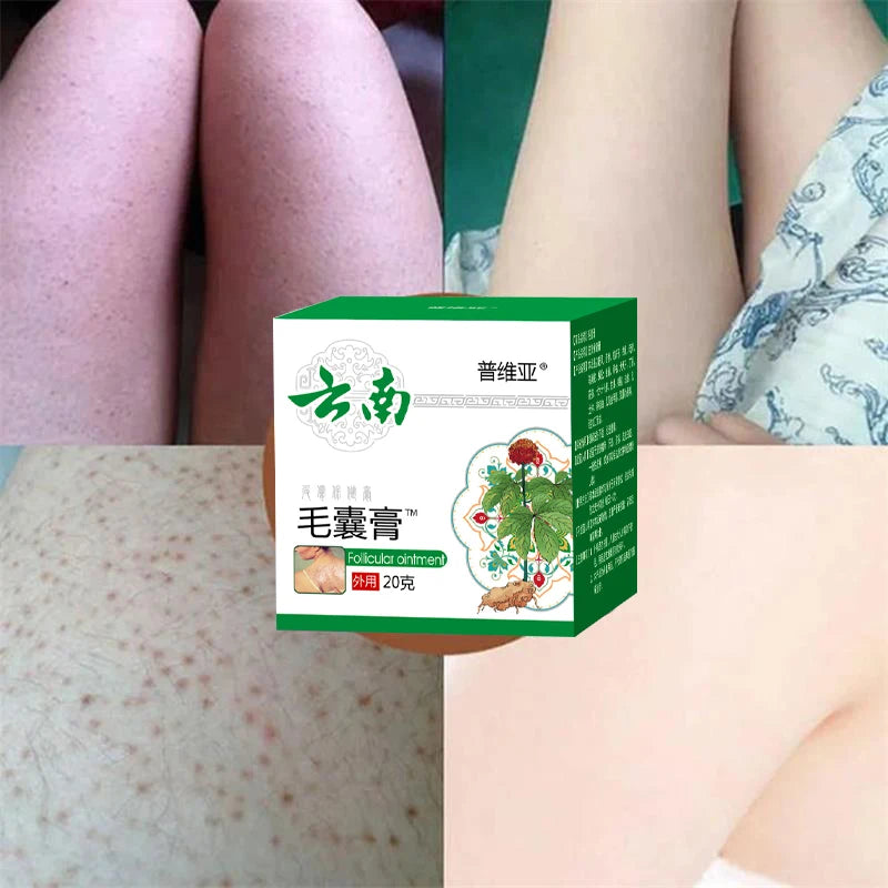 Body Acne Removal Cream Treatment Face Butt Back Acne Marks Smooth Repair Chicken Skin Cream Moisturizing Whitening Skin Care