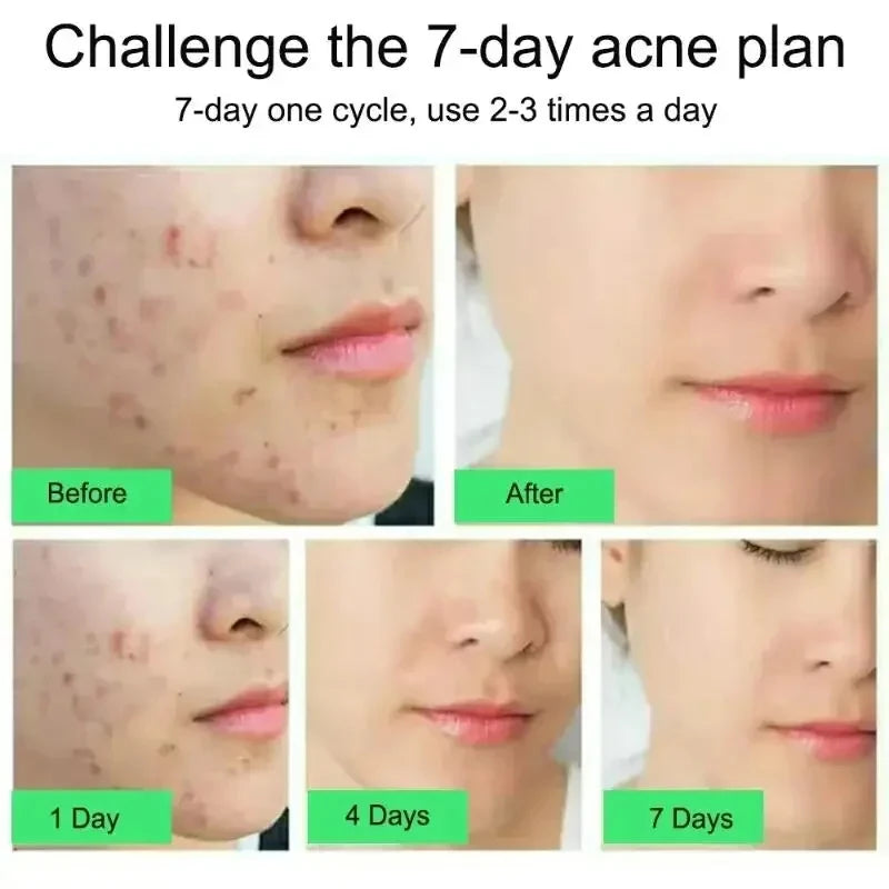 Anti-acne Treatment Cream Salicylic Acid Acne Deep Cleaning Pore Repair Pimple Spots Shrinking Oil Control Moisturizer Skin Care