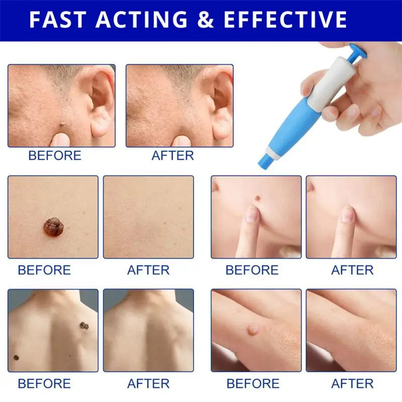 2 In1 Painless Auto Skin Tag Mole Removal Kit Cleaning Tools Face Skin Care Body Dot Treatments Remover Beauty Health