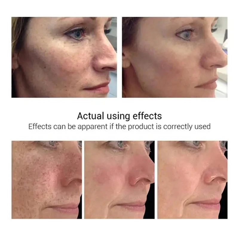 Effective Whitening Freckles Cream Remove Melasma Dark Spots Fade Pigmentation Moisturize Brighten Face Korean Skin Care Product