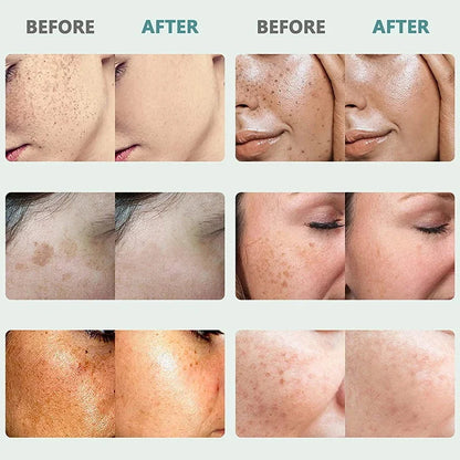 Effective Freckle Cream Fast Brighten Face Remove Melasma Dark Spot Fade Melanin Whiten Anti-pigmentation Improve Dullness Care