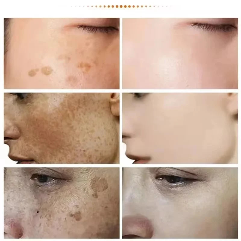 Powerful Spot-removing Whiten Cream Brighten Skin Fast Eliminates Melanin Pigmentation Melasma Dark Spots Korean Skin Care