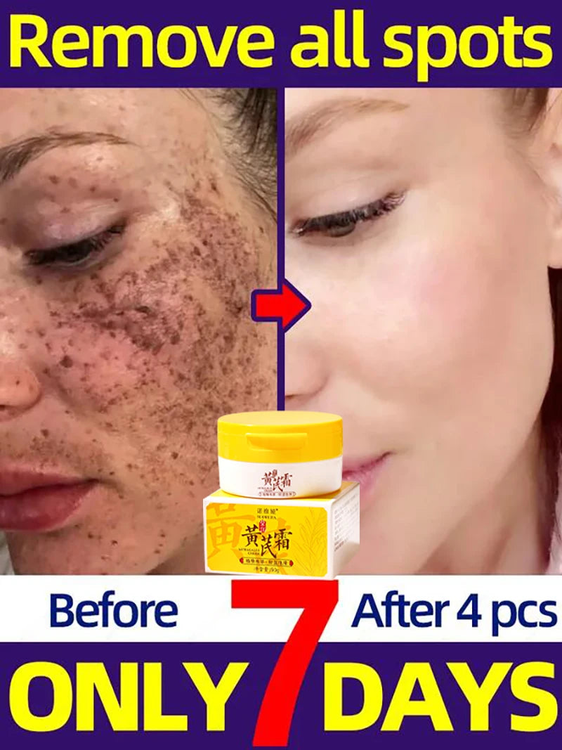 Astragalus Whitening Freckles Face Cream Remove Dark Spots Melasma Lighten Melanin Acne Scars Anti-aging Brighten Skin Care 50g