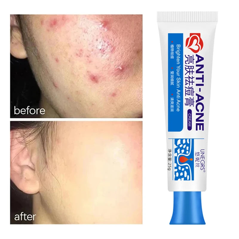 Anti-acne Treatment Cream Salicylic Acid Acne Deep Cleaning Pore Repair Pimple Spots Shrinking Oil Control Moisturizer Skin Care