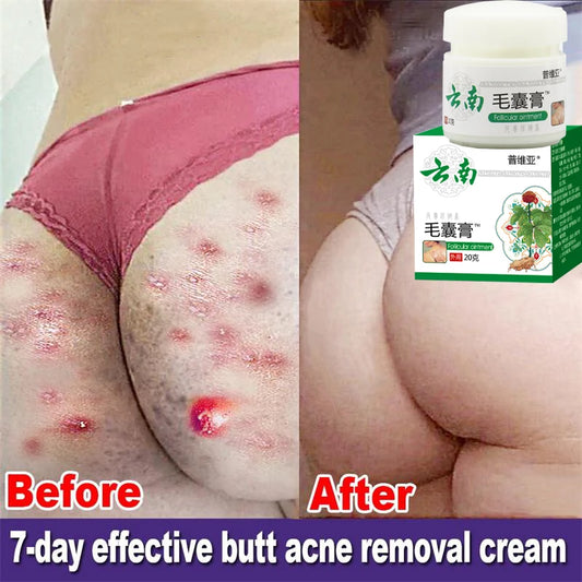 Body Acne Removal Cream Treatment Face Butt Back Acne Marks Smooth Repair Chicken Skin Cream Moisturizing Whitening Skin Care