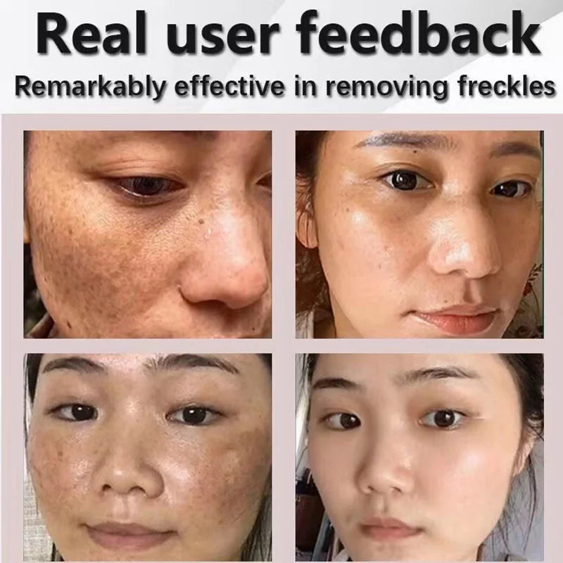 Powerful Whiten Freckle Cream Fast Remove Melasma Melanin Correcter Anti-Pigmentation Dark Spot Fade Improve Dullness Skin Care