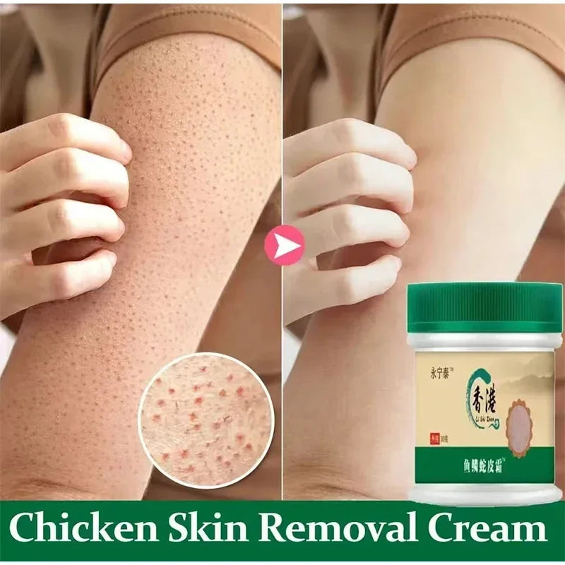 Chicken Skin Removal Treatment Body Scrub Cream Remove Dead Skin Cell Pore Spot Dull Whitening Moisturizing Body Care Cream