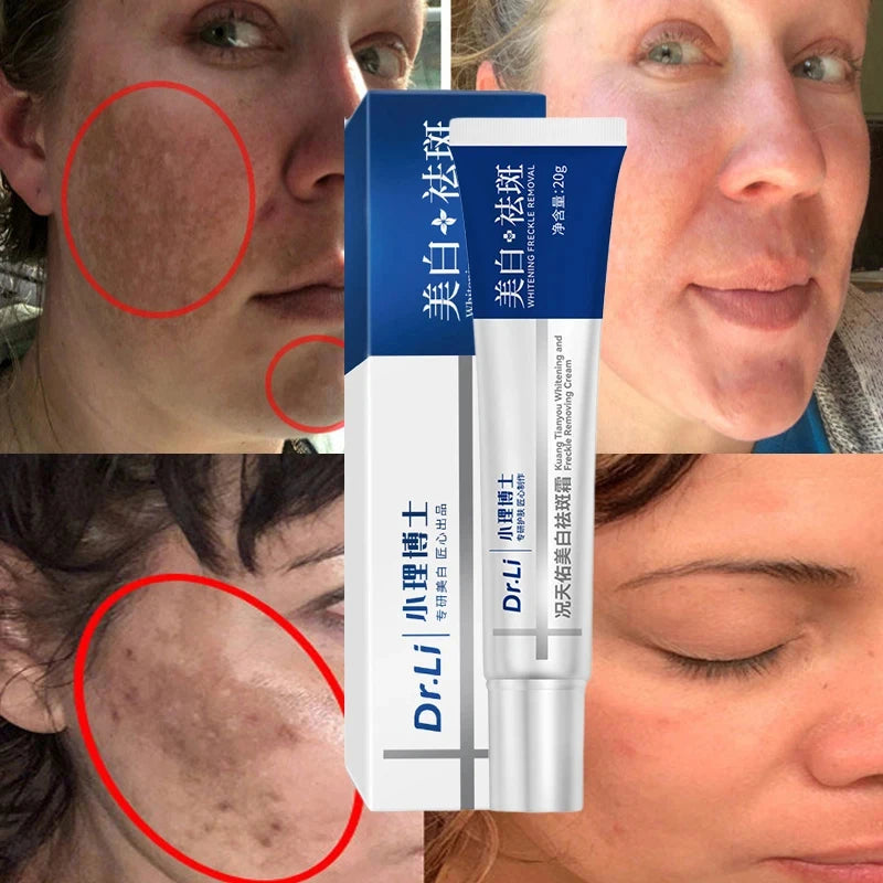 Effective Whitening Freckles Cream Remove Melasma Dark Spots Fade Pigmentation Moisturize Brighten Face Korean Skin Care Product