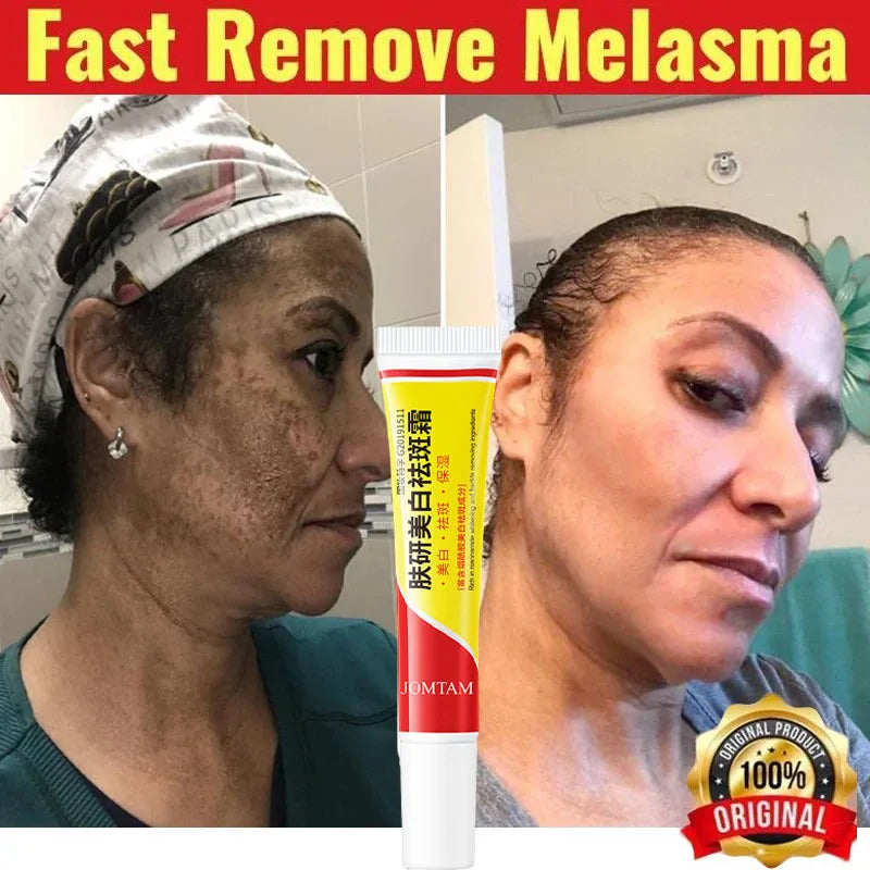 Effective Freckle Cream Fast Brighten Face Remove Melasma Dark Spot Fade Melanin Whiten Anti-pigmentation Improve Dullness Care